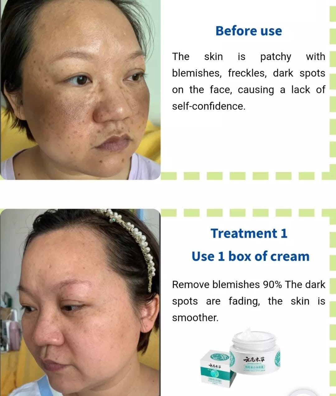 HOT JAPANESE Melasma Cream | Dark Spots Removal Cream