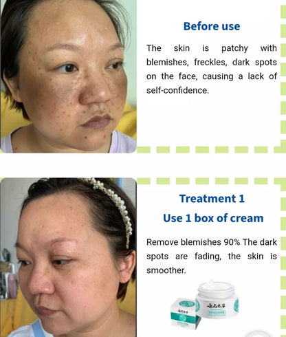 HOT JAPANESE Melasma Cream | Dark Spots Removal Cream