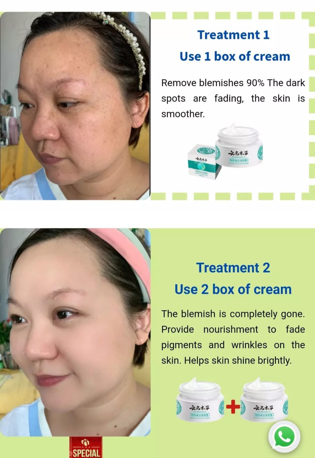 HOT JAPANESE Melasma Cream | Dark Spots Removal Cream